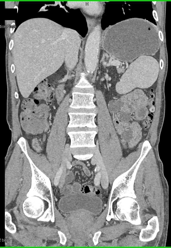 Incidental Splenic Hamartoma in Patient with End Stage Renal Disease (ESRD) and Renal Transplant - CTisus CT Scan