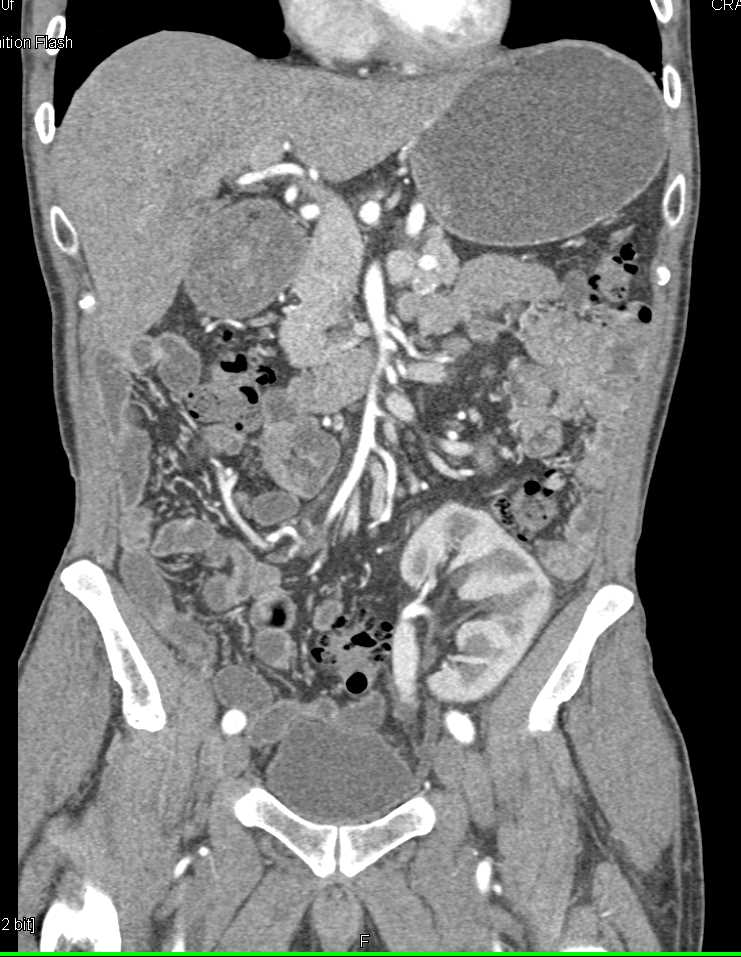 Incidental Splenic Hamartoma in Patient with End Stage Renal Disease (ESRD) and Renal Transplant - CTisus CT Scan