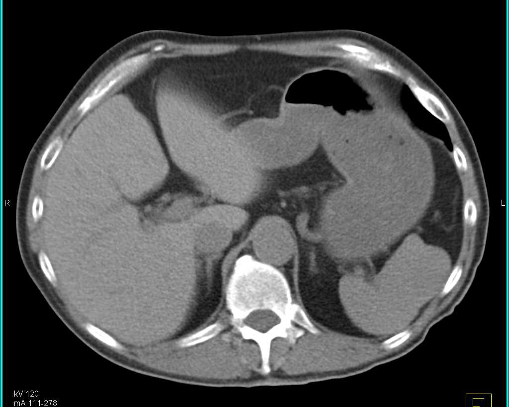 Splenic Hamartoma - CTisus CT Scan