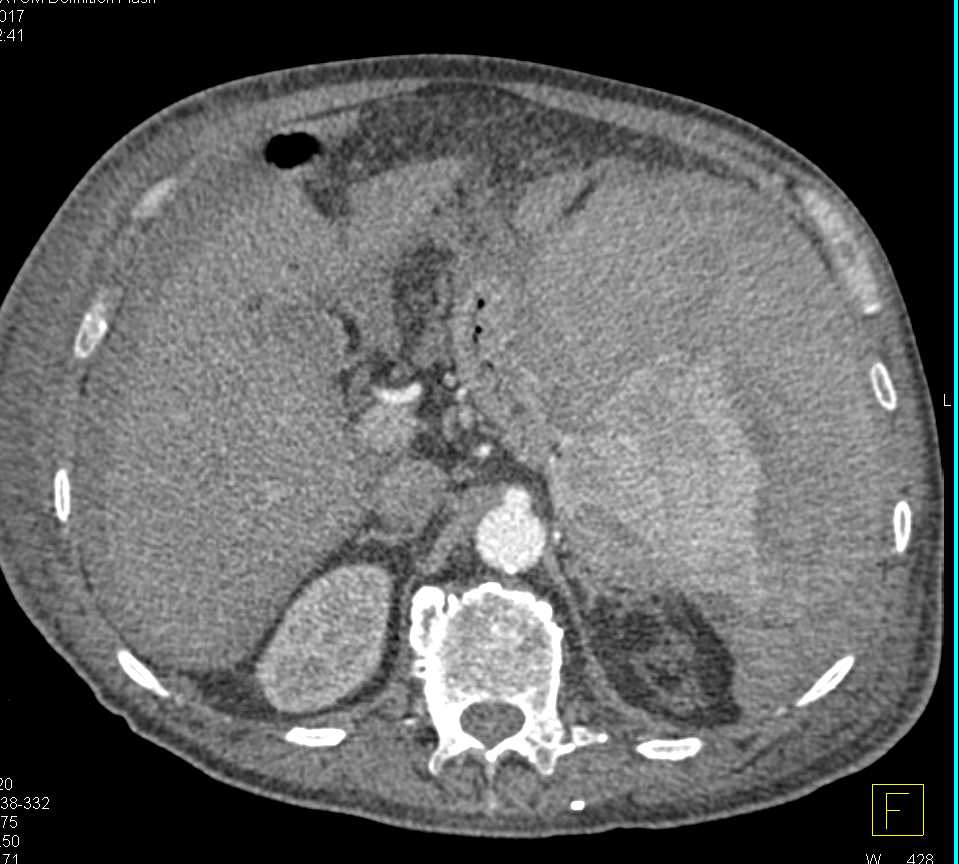 Splenic Rupture with Hemoperitoneum - CTisus CT Scan