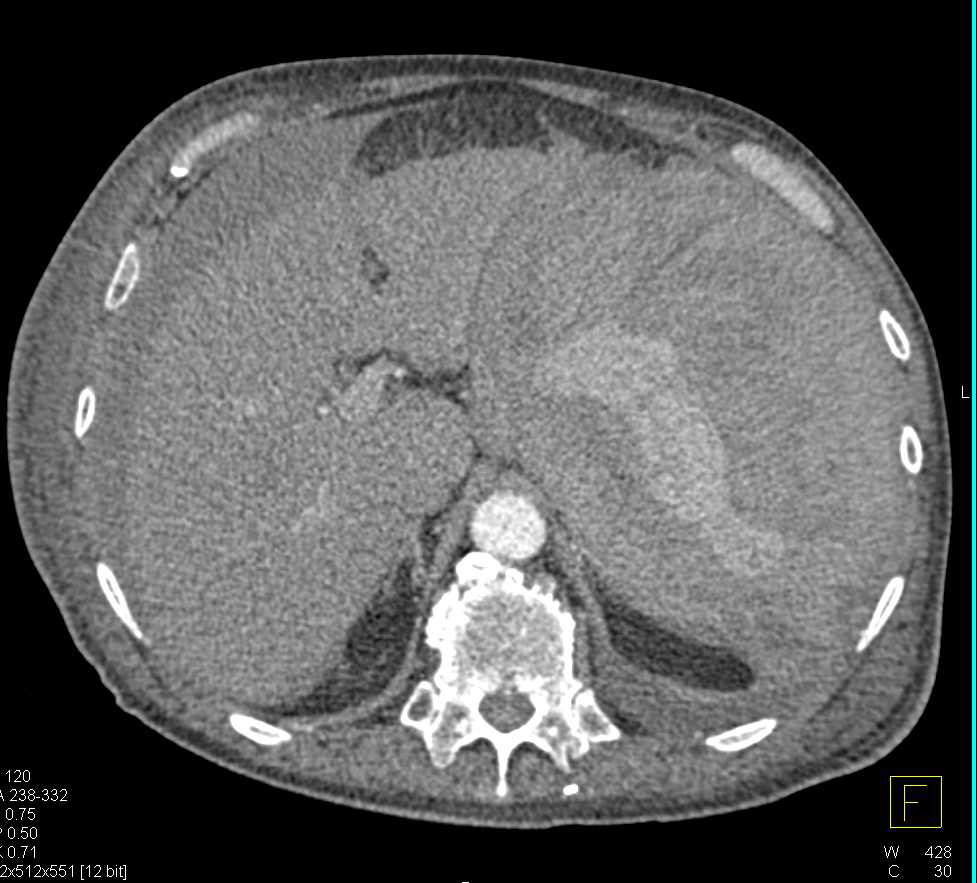 Hemoperitoneum with Spontaneous Splenic Bleed - CTisus CT Scan