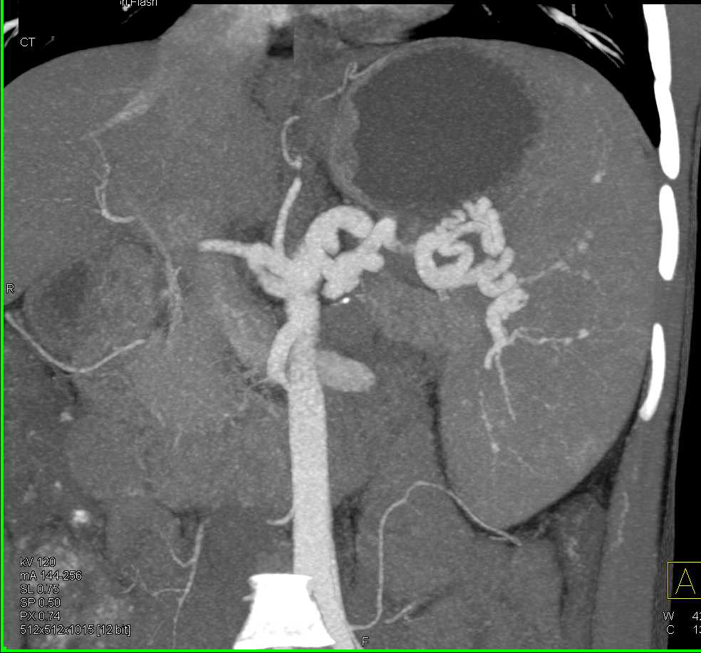 Multiple Small Splenic Artery Aneurysms - CTisus CT Scan