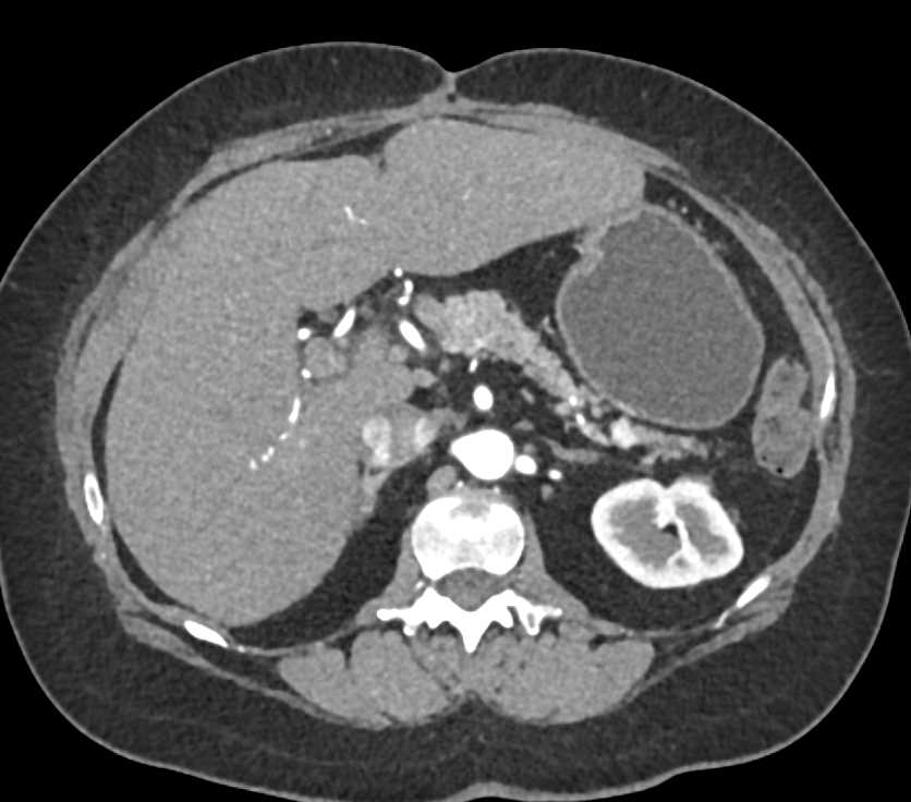 Omental Infarct in Splenic bed - CTisus CT Scan