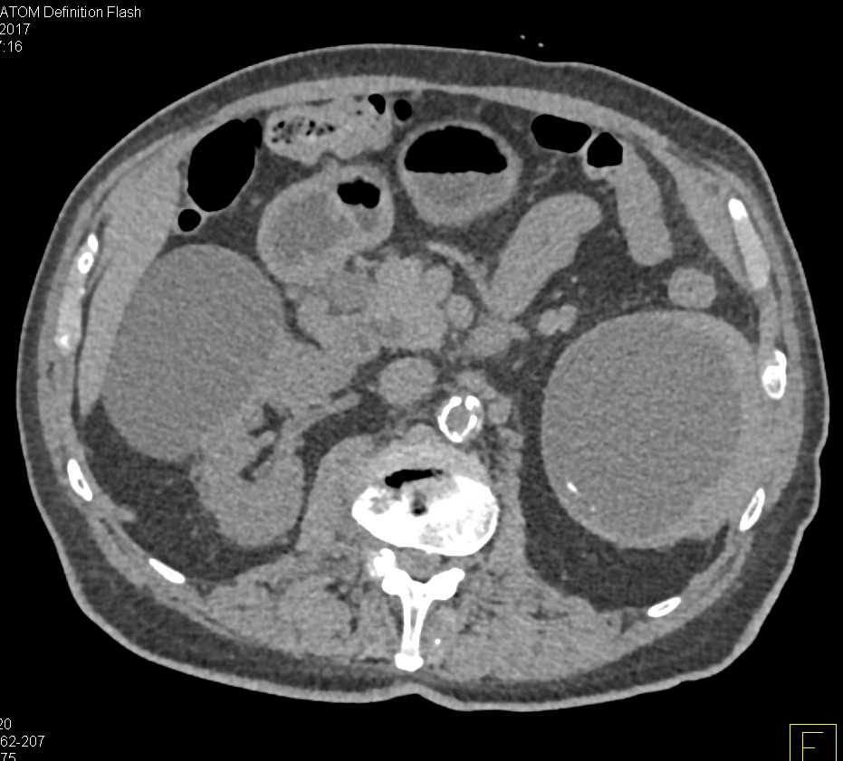 Splenic Hemangioma and Pancreas Cancer - CTisus CT Scan