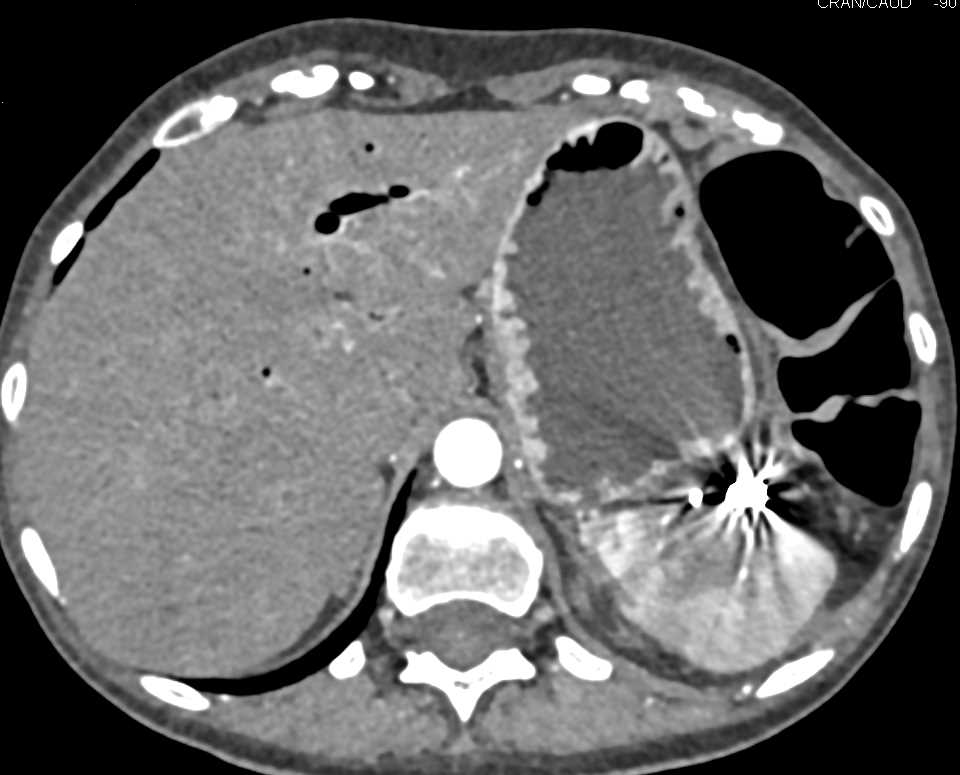 Splenic Infarct Becomes a Splenic Abscess - CTisus CT Scan