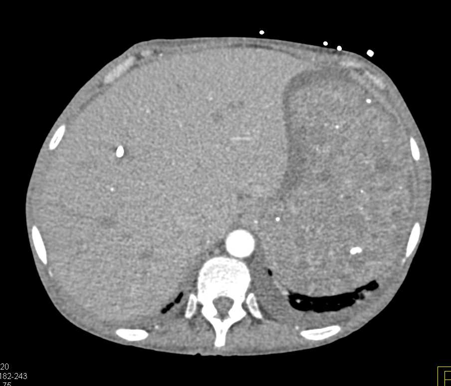 Splenic Hemangiomas in Klippel-Trenaunay-Weber (KTW) Syndrome - CTisus CT Scan