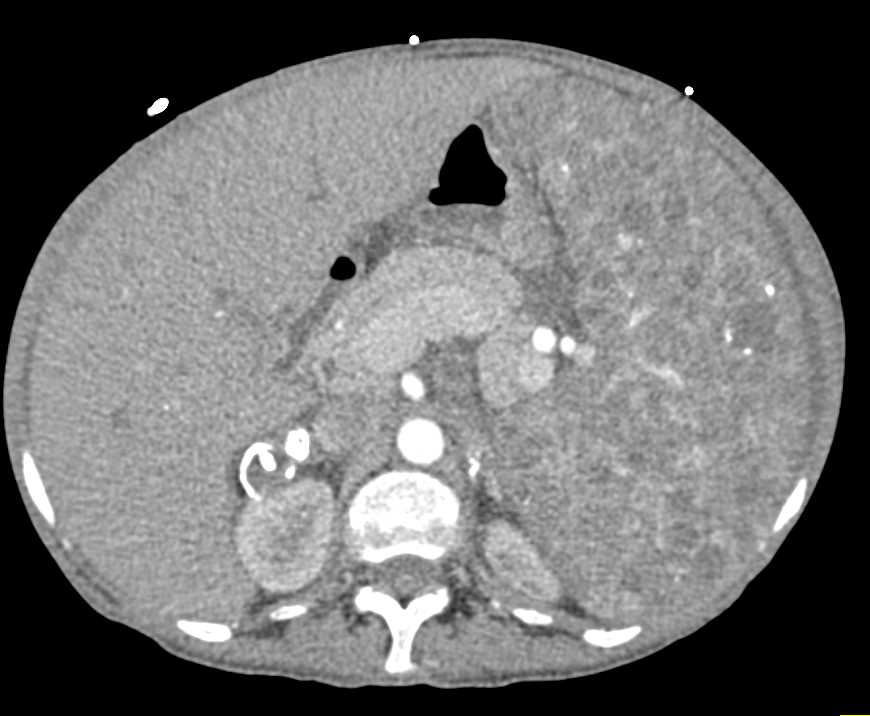 Splenic Hemangiomas in Klippel-Trenaunay-Weber (KTW) Syndrome as Well as Bladder and Right Adrenal Hemangioma - CTisus CT Scan