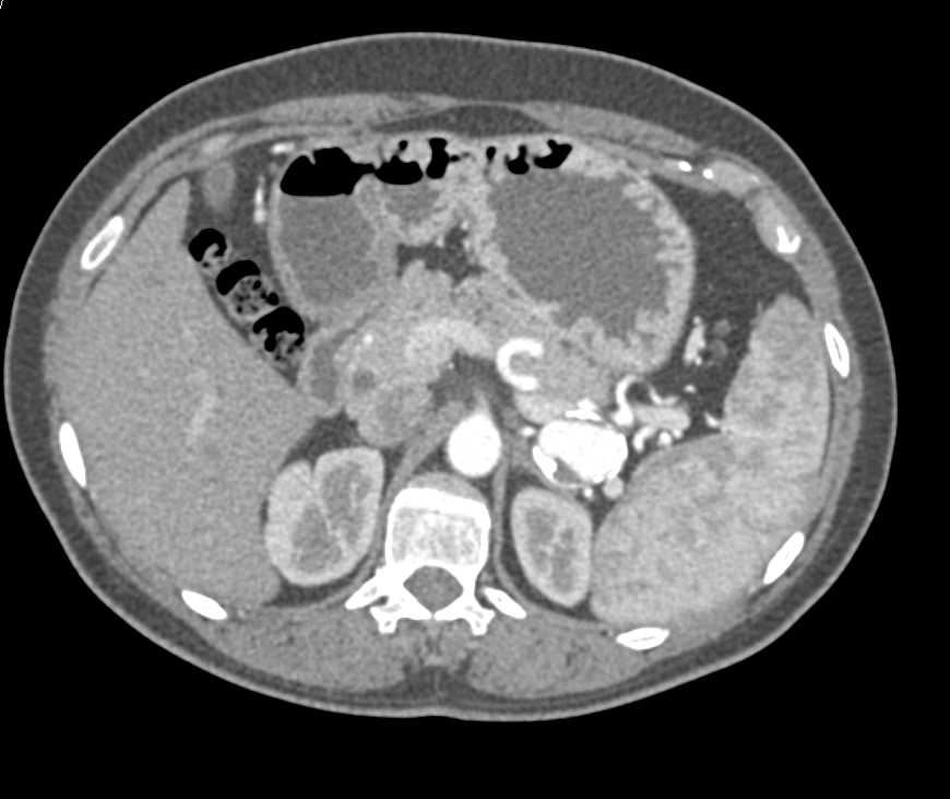 Splenic Artery Aneurysm - CTisus CT Scan