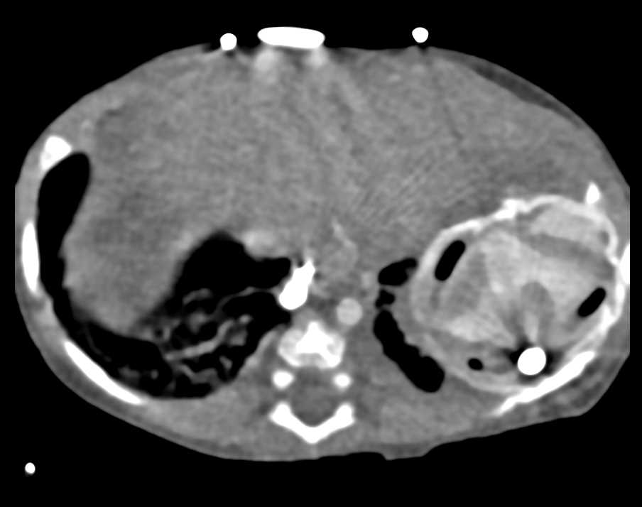 Splenic Injury s/p Trauma - CTisus CT Scan