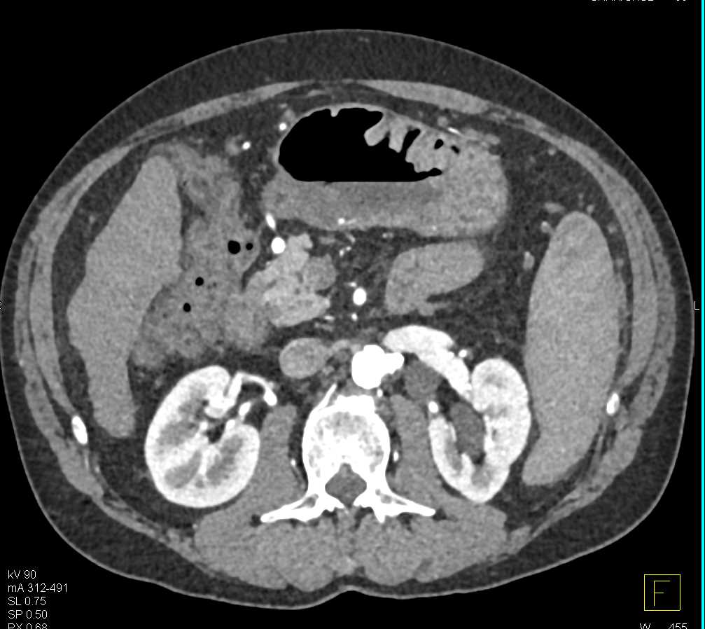 Gastritis due to Alcohol Abuse - CTisus CT Scan