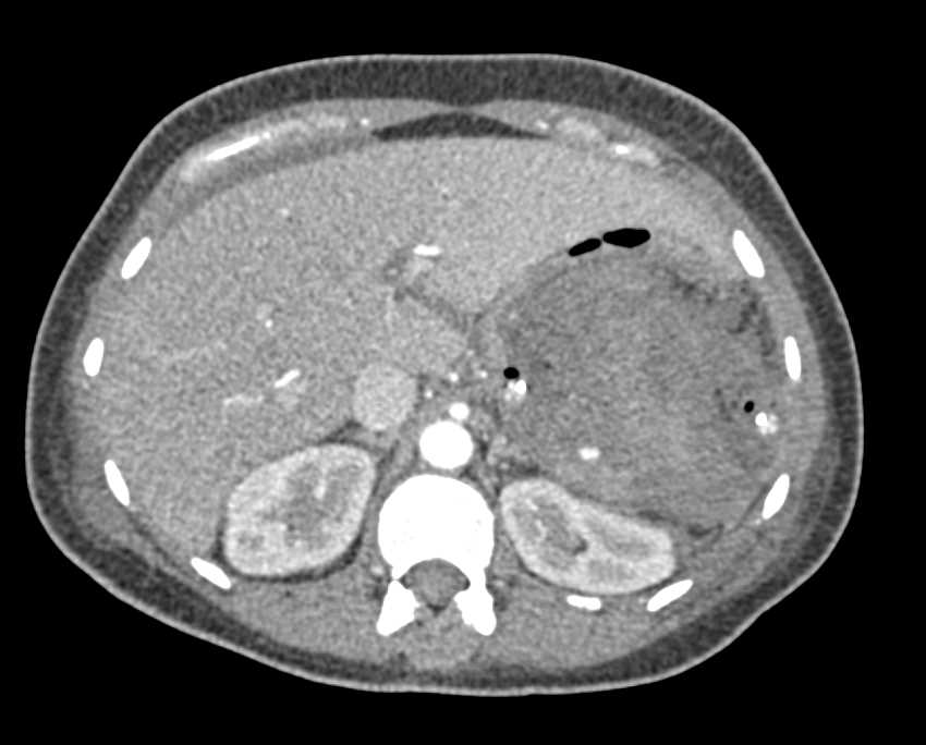 Active Bleed Left Upper Quadrant s/p Splenectomy - CTisus CT Scan