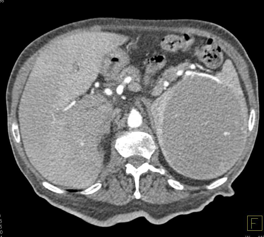 Splenic Hamartoma - CTisus CT Scan