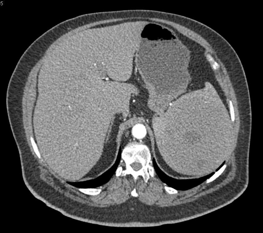 Splenic Hamartoma - CTisus CT Scan