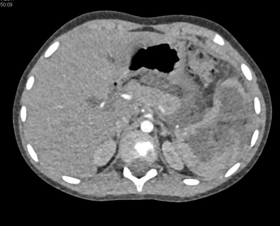 Splenic Cyst Became Infected with Abscess - CTisus CT Scan