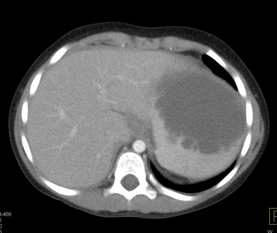 Splenic Cyst Became Infected with Abscess - CTisus CT Scan