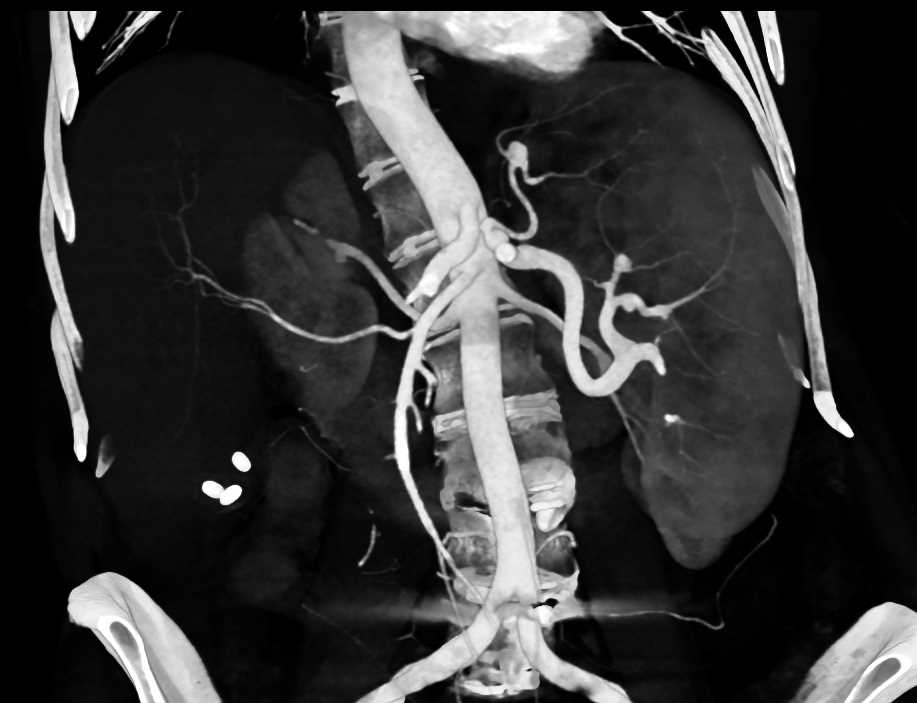 Huge Esophageal Varices and Splenic Artery Aneurysms - CTisus CT Scan