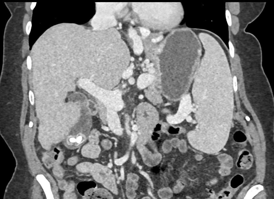 Huge Esophageal Varices and Splenic Artery Aneurysms - CTisus CT Scan