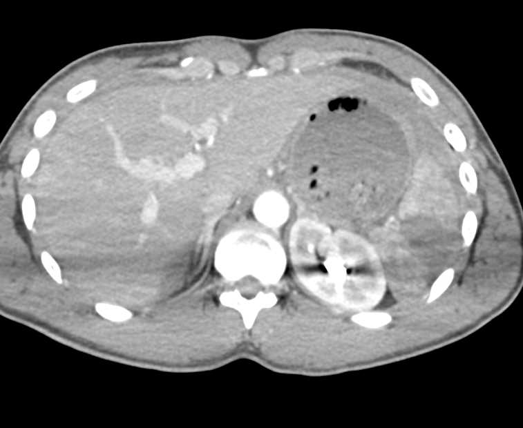 Splenic Laceration and Hemoperitoneum - CTisus CT Scan