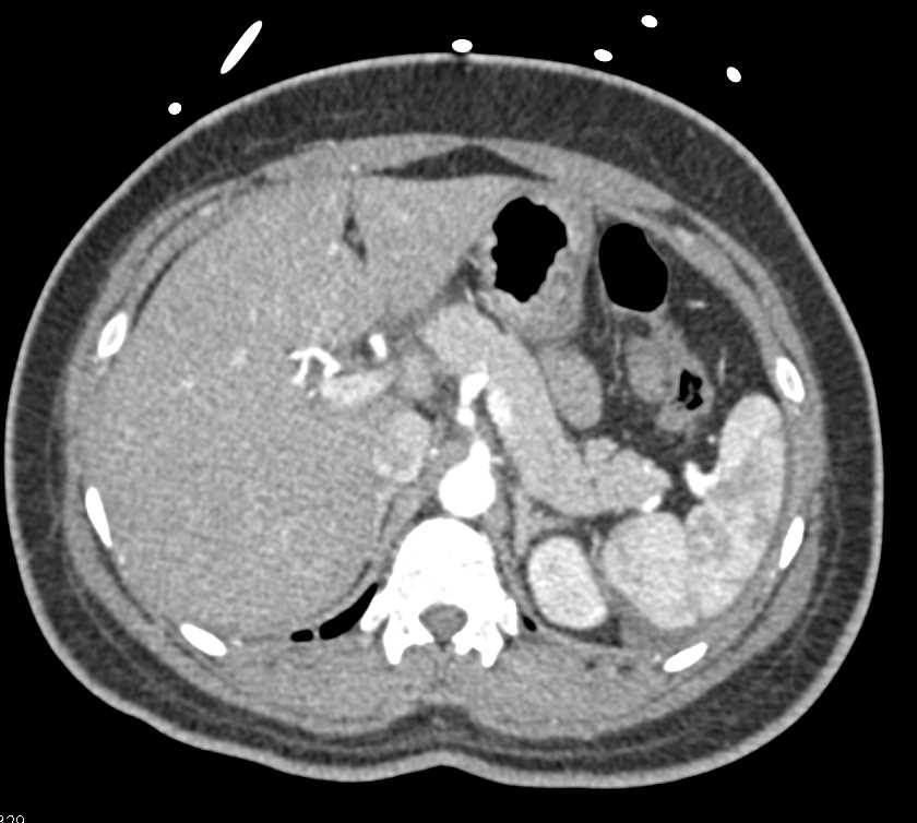 Splenic Laceration and Bleed - CTisus CT Scan