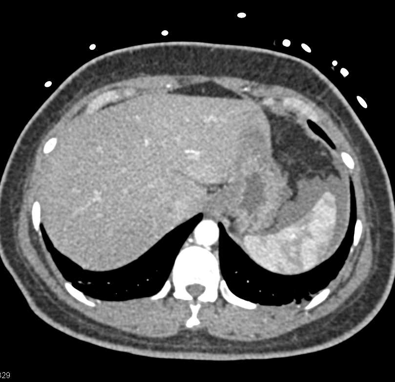 Splenic Laceration with Hemoperitoneum - CTisus CT Scan