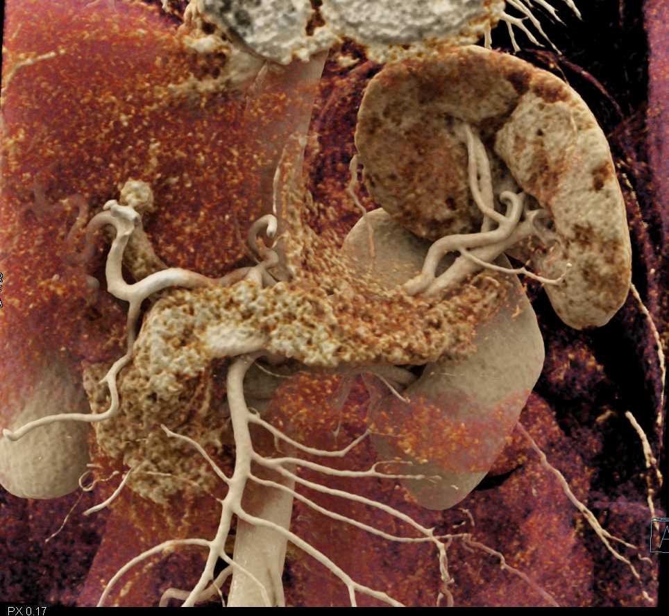 needs dxNormal Pancreas and Spleen with Cinematic Rendering - CTisus CT Scan