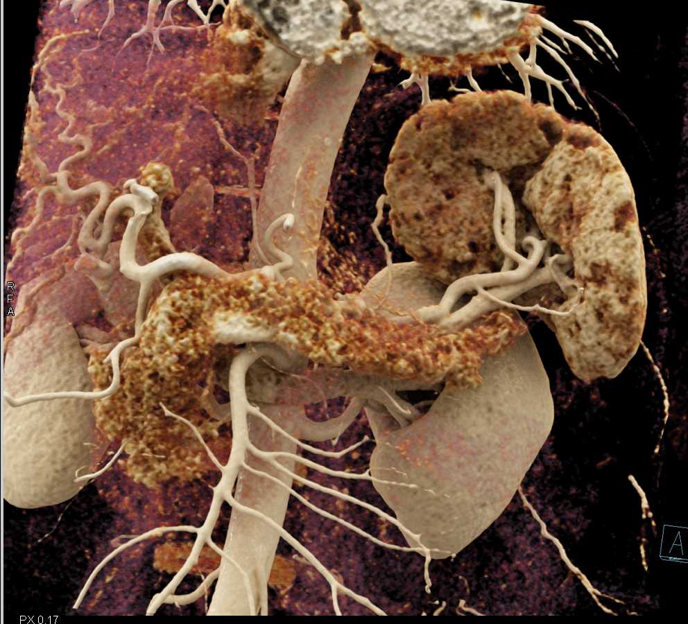 needs dxNormal Pancreas and Spleen with Cinematic Rendering - CTisus CT Scan