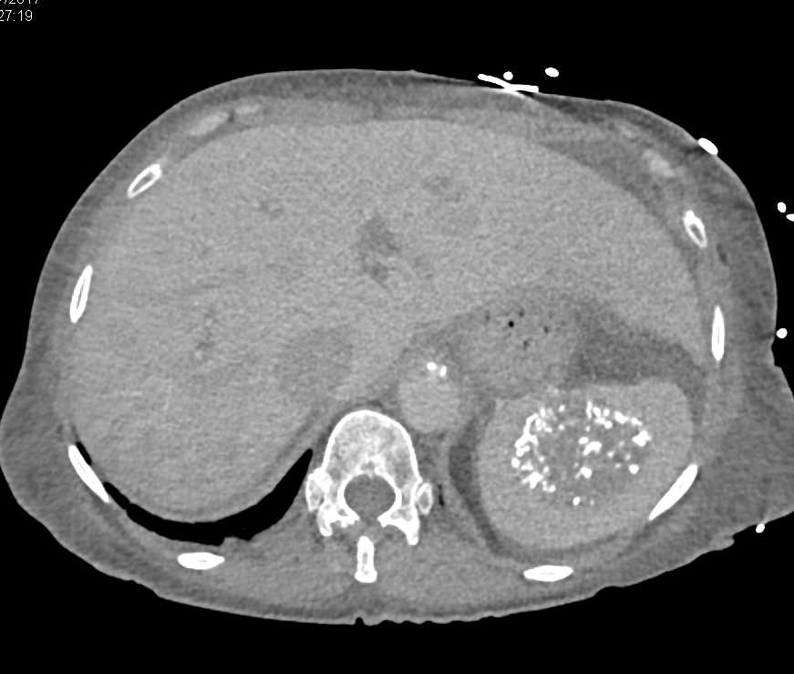 Calcified Splenic Hemangioma - CTisus CT Scan