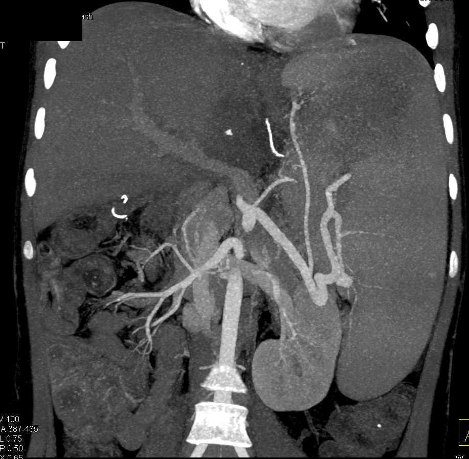 Splenomegaly and Liver Infarct - CTisus CT Scan