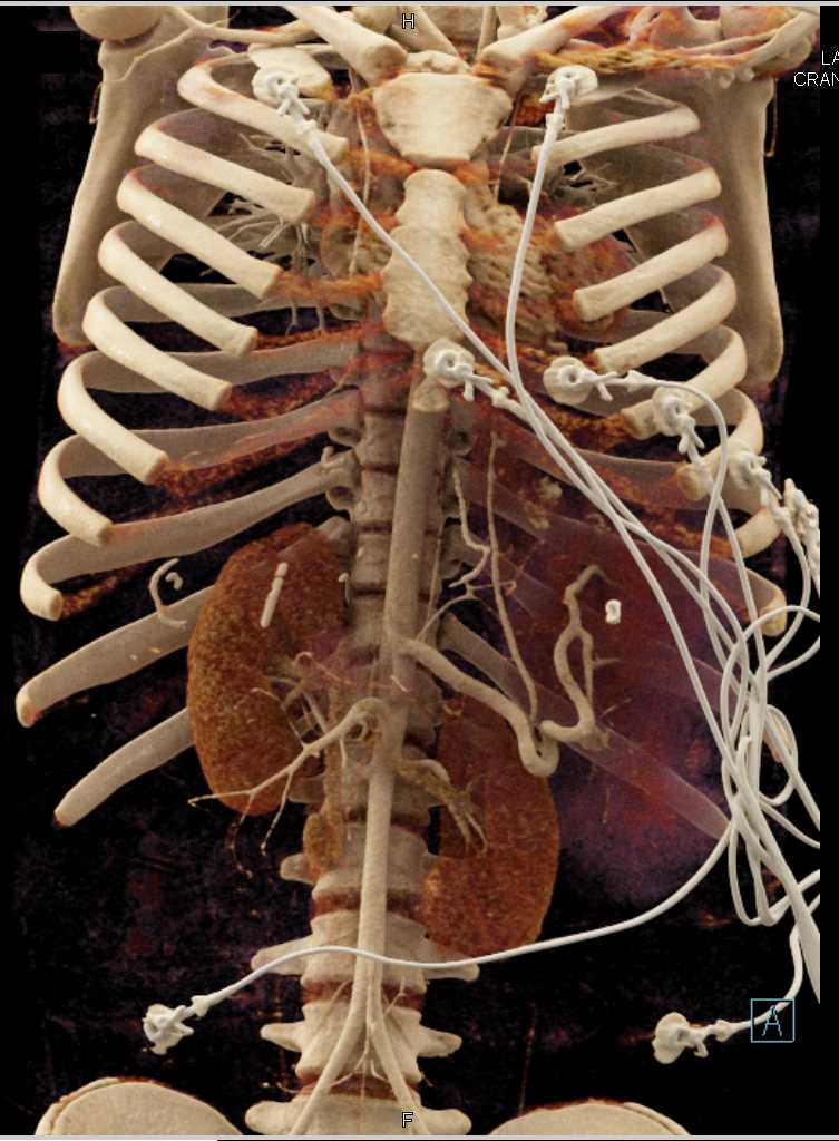 Splenomegaly - CTisus CT Scan