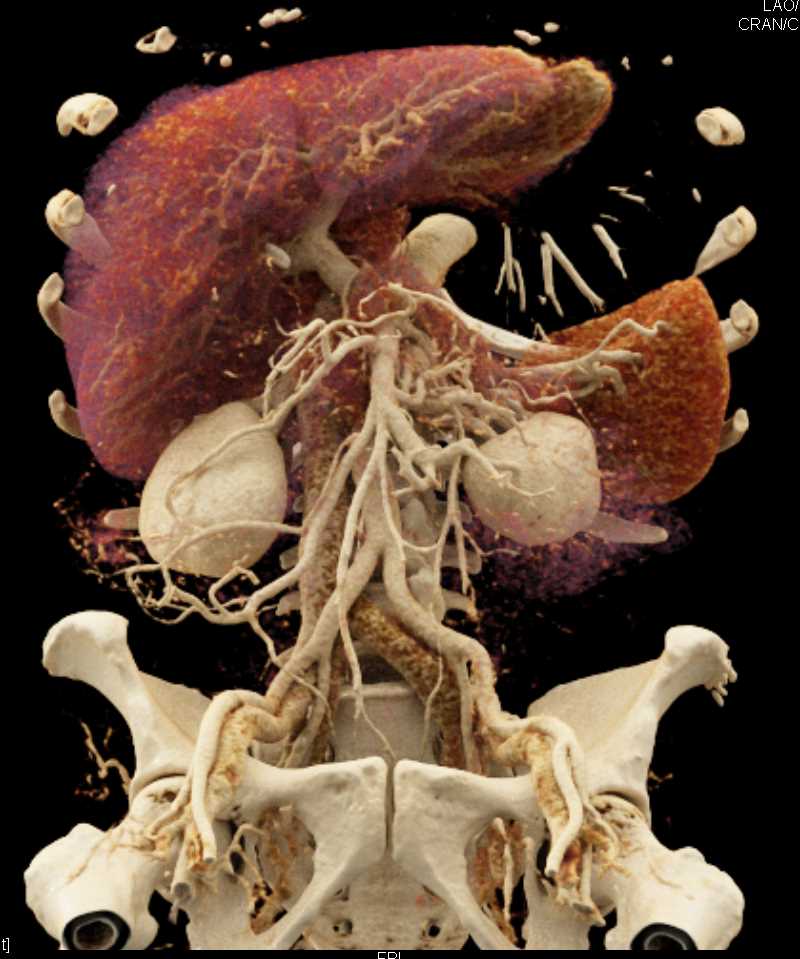 Texture Mapping of the Spleen - CTisus CT Scan