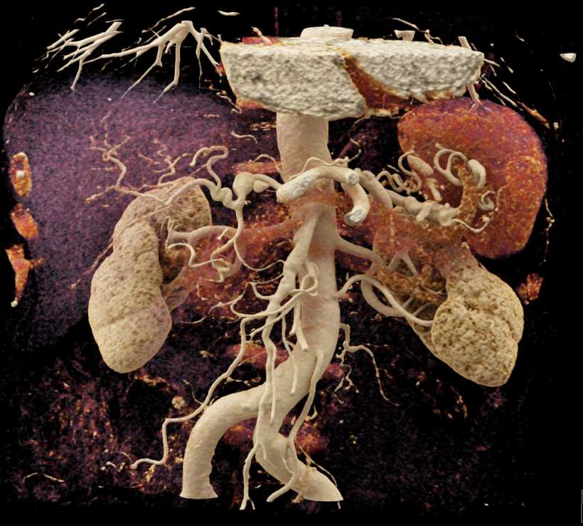 Small Splenic Artery Aneurysm - CTisus CT Scan