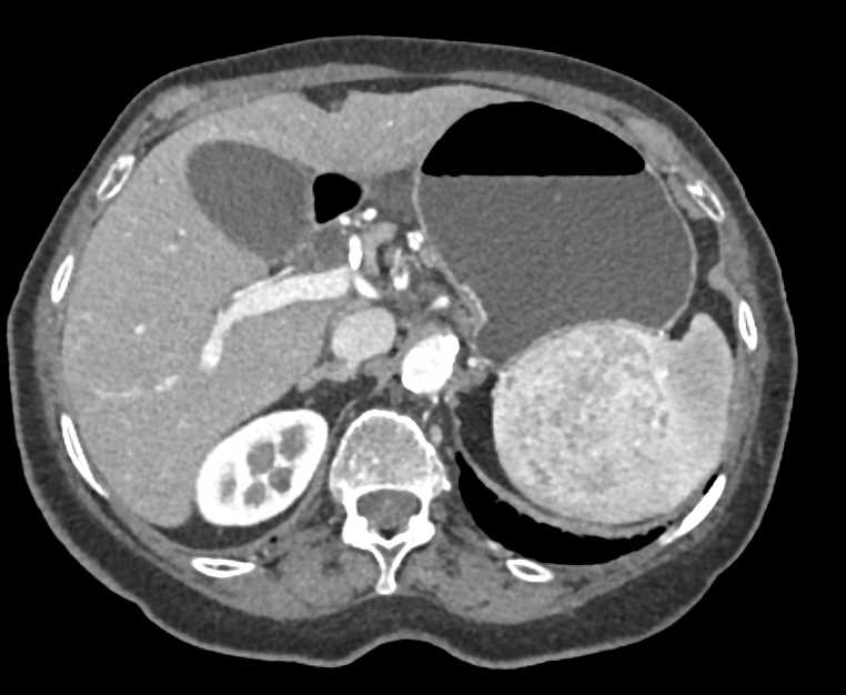 Splenic Hamartoma - Spleen Case Studies - CTisus CT Scanning