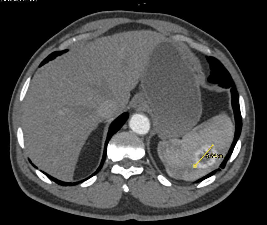 Splenic Hemangioma - CTisus CT Scan