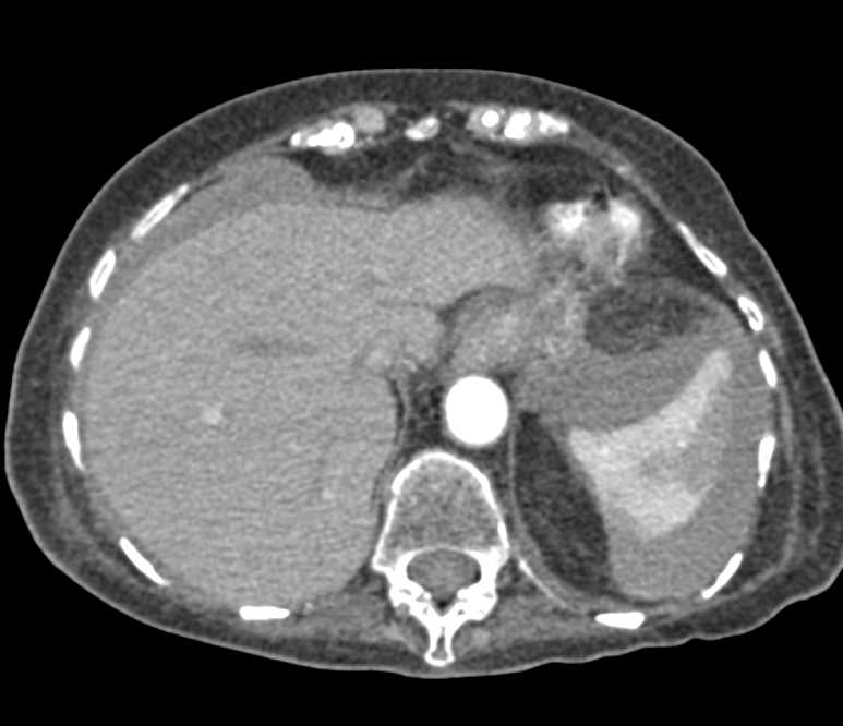 Splenic Laceration with Hemoperitoneum - CTisus CT Scan