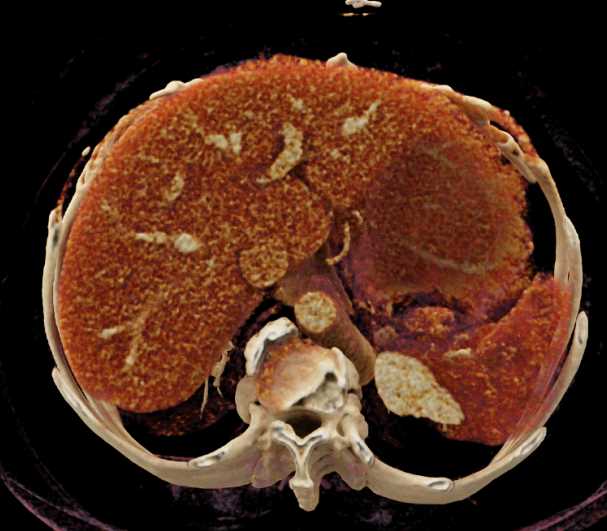 Primary Splenic Lymphoma - CTisus CT Scan