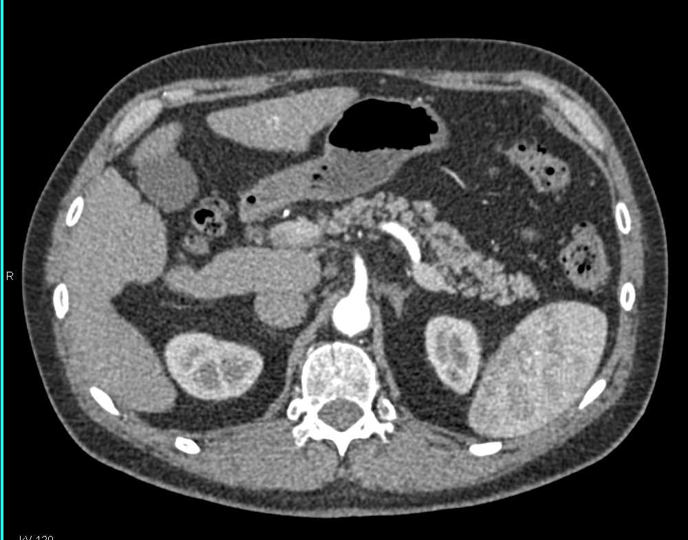 Splenic Artery in 3D - CTisus CT Scan