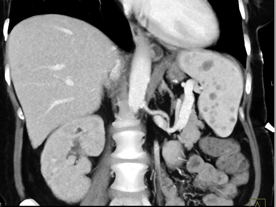 Multiple Splenic and Renal Abscess due to Candidiasis - CTisus CT Scan