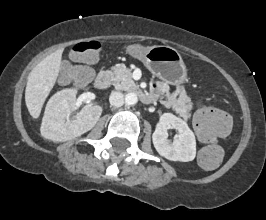Multiple Splenic and Renal Abscess due to Candidiasis - CTisus CT Scan