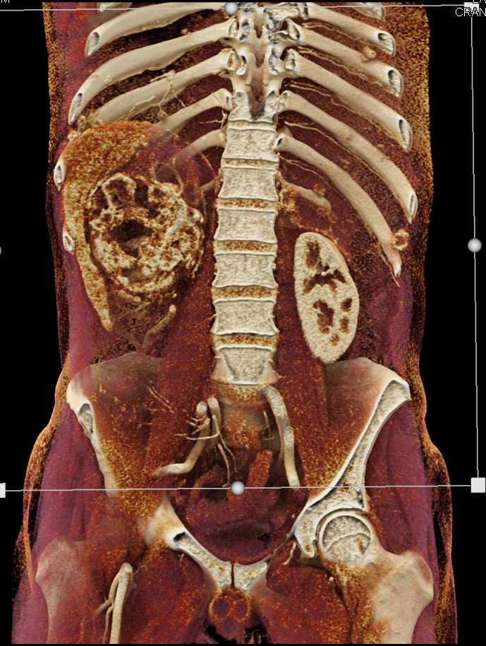 Renal Cell Carcinoma with Vascular Invasion and Infarcted Spleen - CTisus CT Scan
