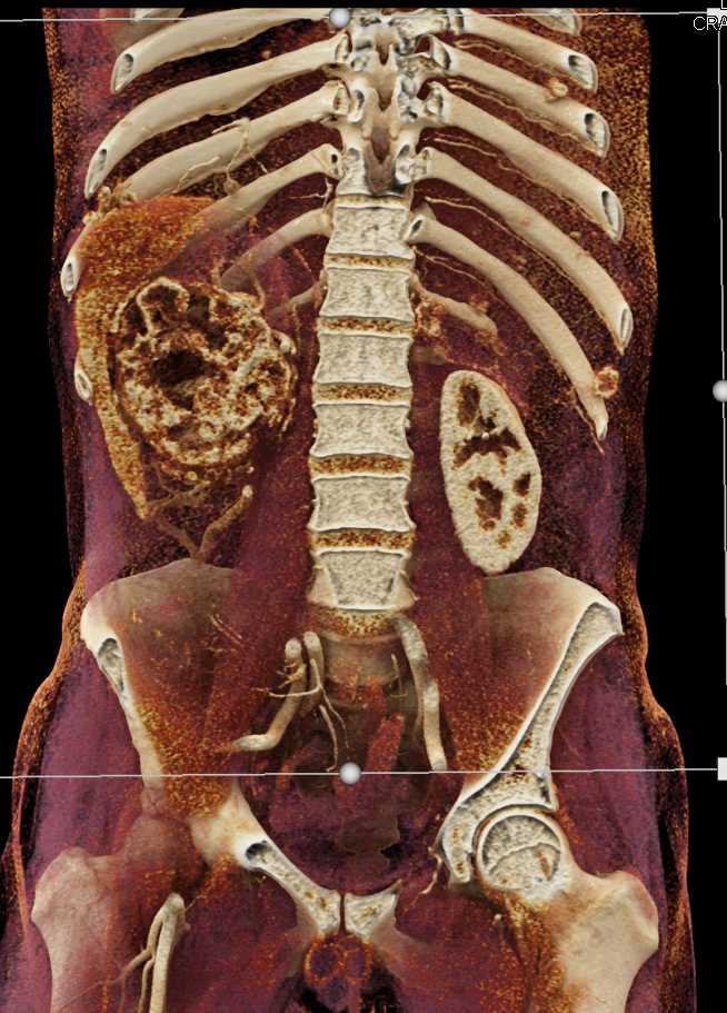 Renal Cell Carcinoma with Vascular Invasion and Infarcted Spleen - CTisus CT Scan