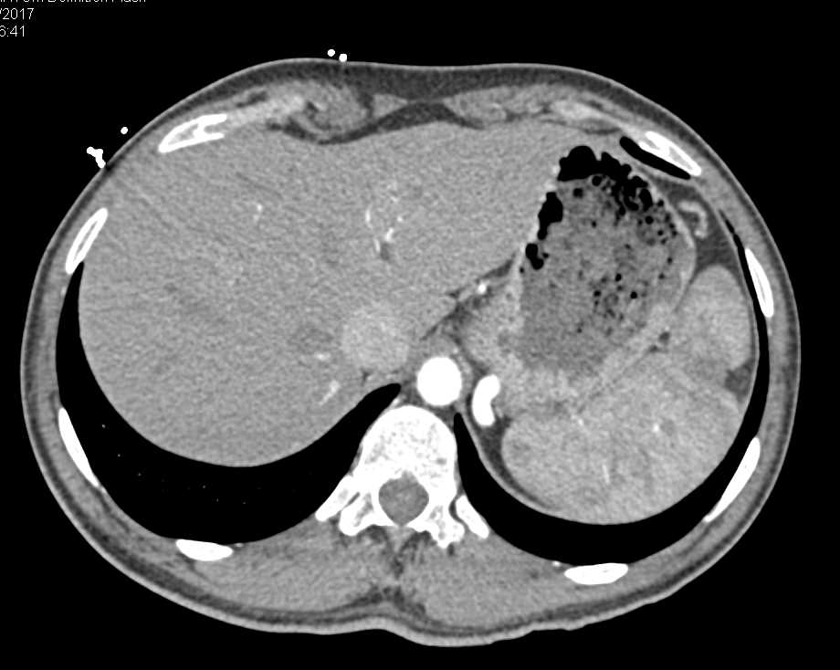 Splenic Infarcts and Renal Infarcts - CTisus CT Scan