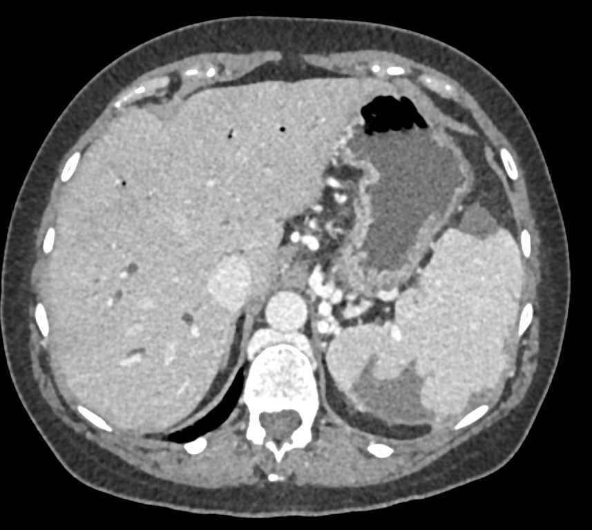 Pancreatic Cancer and Splenic Infarcts - CTisus CT Scan