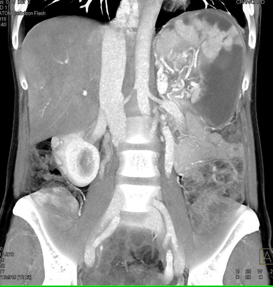 Splenic Infarcts - CTisus CT Scan