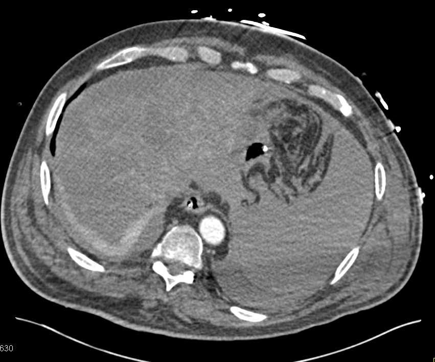Hemoperitoneum due to Splenic Laceration - CTisus CT Scan
