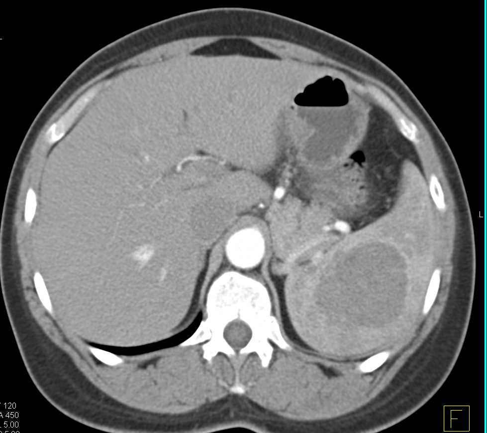 Splenic Hemangioma - CTisus CT Scan