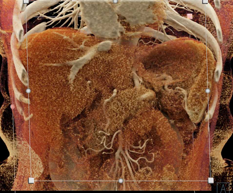 Splenic Hemangioma - CTisus CT Scan