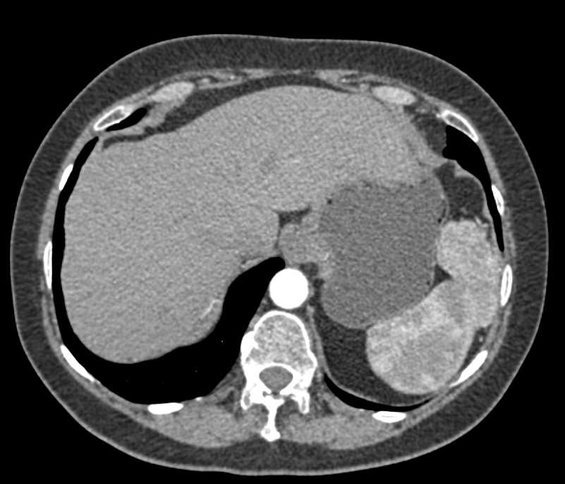 Unusual Accesory Spleen - CTisus CT Scan