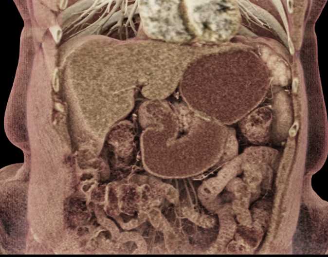 Unusual Accesory Spleen - CTisus CT Scan