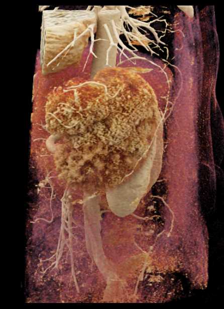 Unusual Accesory Spleen - CTisus CT Scan