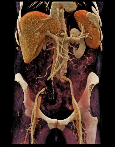 Unusual Accesory Spleen with CR - CTisus CT Scan